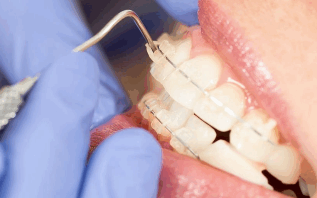 Aparatele Dentare – Ghid complet pentru un zâmbet sănătos și aliniat