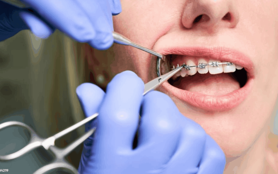 Când trebuie pus aparat dentar la copii – semne că este nevoie de tratament ortodontic