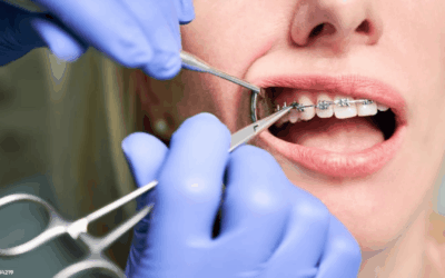 Când trebuie pus aparat dentar la copii – semne că este nevoie de tratament ortodontic