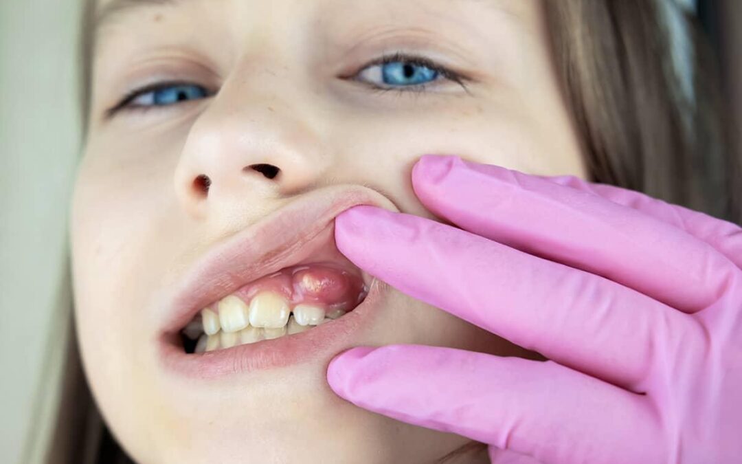 Așchia unui dinte de lapte afectează apariția dintelui permanent?